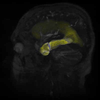 Ventricles_Segmented_Opacity_Tone